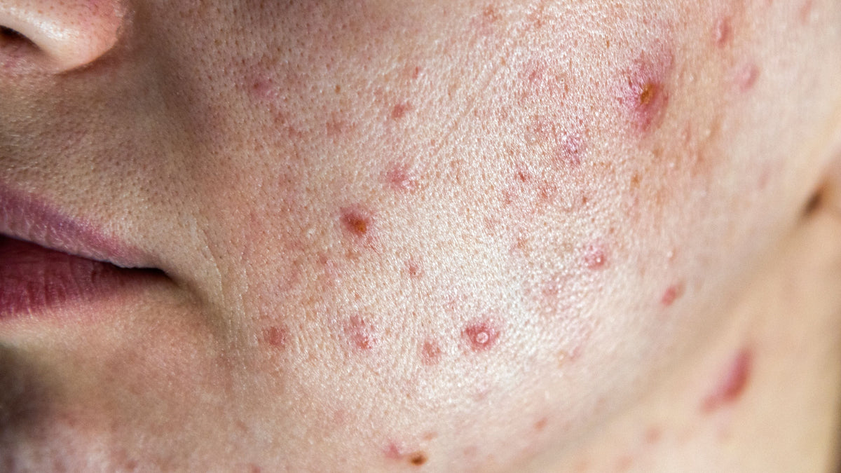 gezicht met hormonale acne