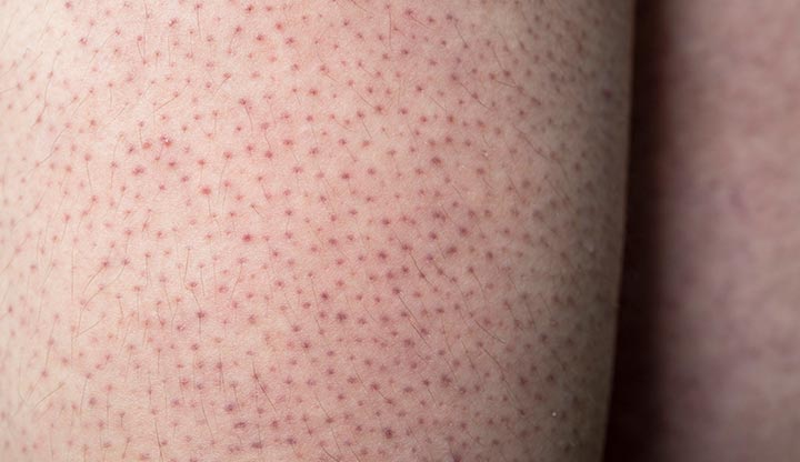 huid met duidelijke bultjes oftewel keratosis pilaris