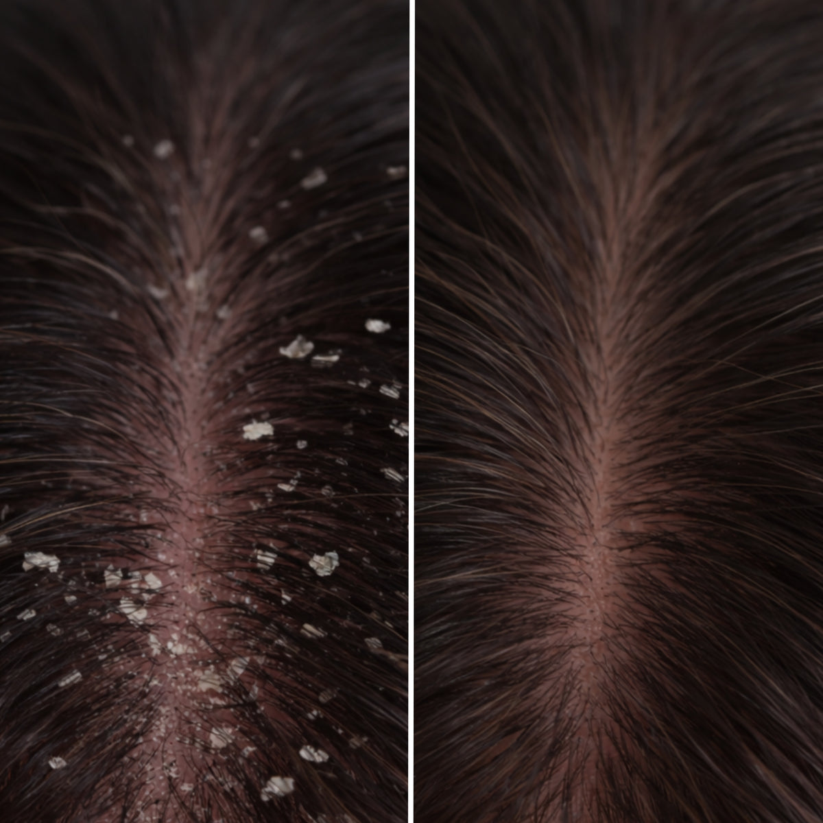 Before en after van de hoofdhuid na gebruik van de It Starts at the Roots scalp treatment van Skin for Skin