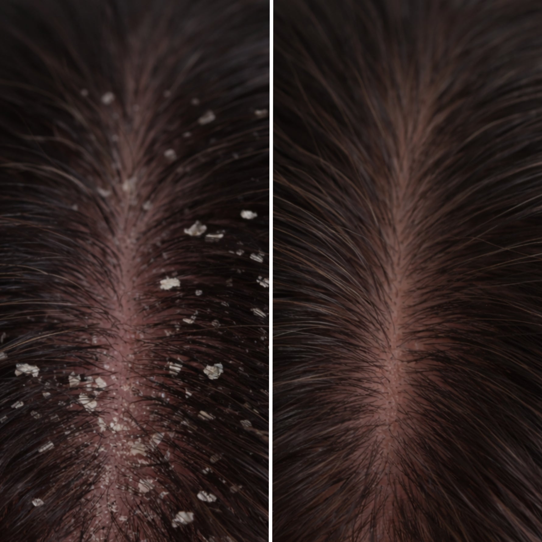 Before en after van de hoofdhuid na gebruik van de It Starts at the Roots scalp treatment van Skin for Skin