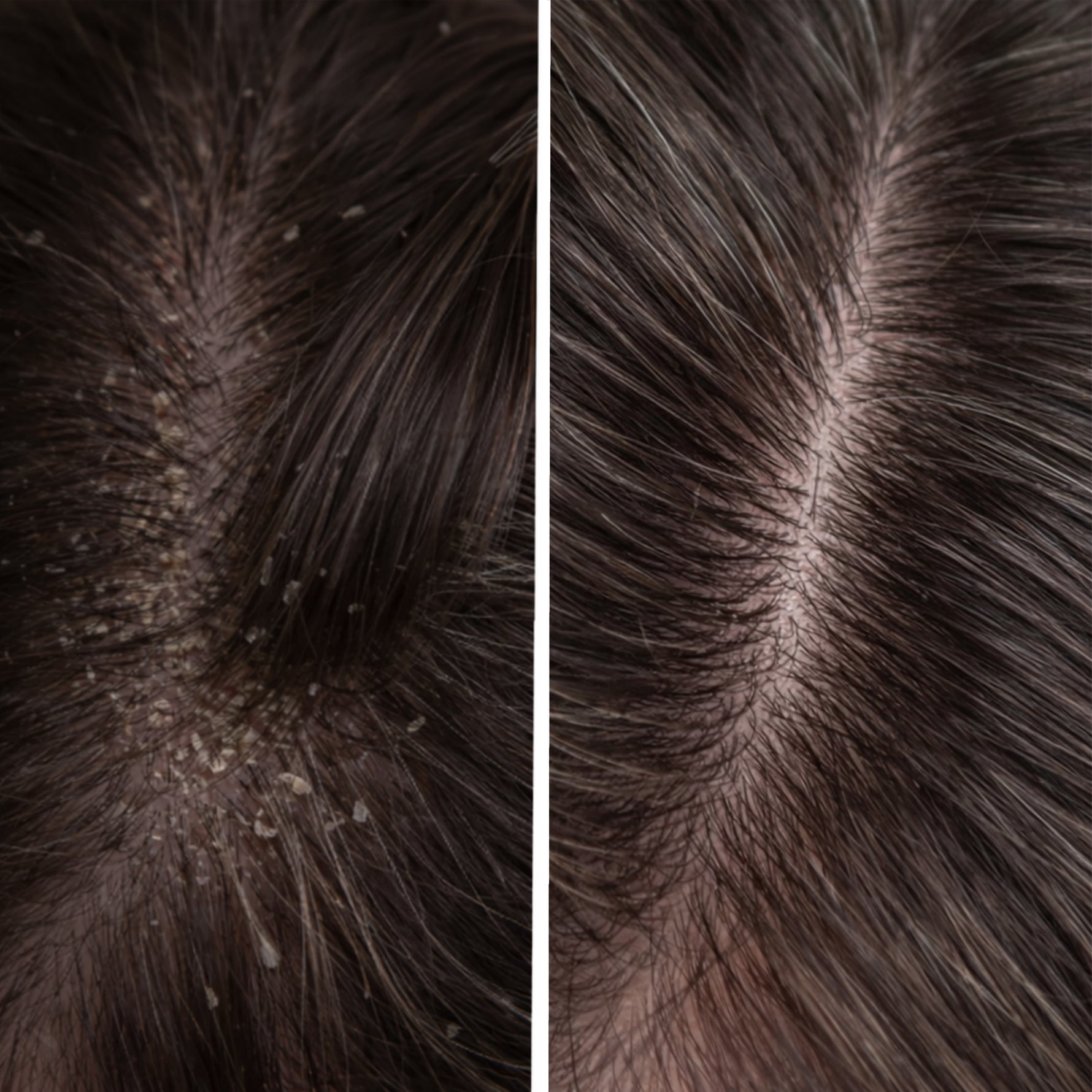 Before en after van de hoofdhuid na gebruik van de Scrub That Scalp scalp scrub van Skin for Skin