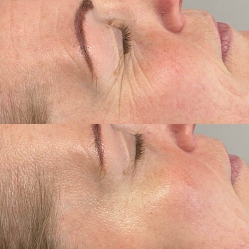 Pure collagen eye sheets before and after photo of face