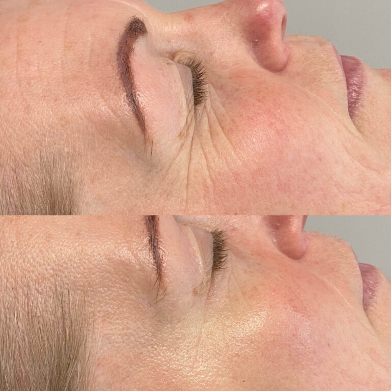 Pure collagen eye sheets before and after photo of face